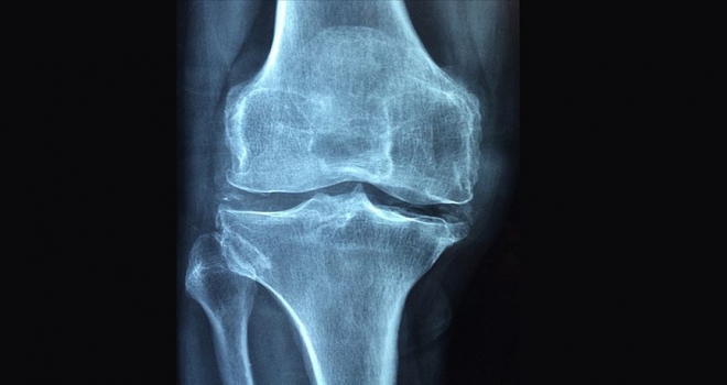 Romatizmal hastalıklar osteoporoz riskini artırıyor