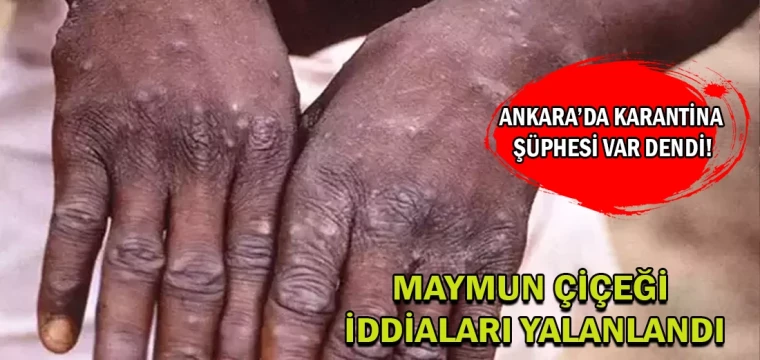 Maymun çiçeği iddiaları yalanlandı