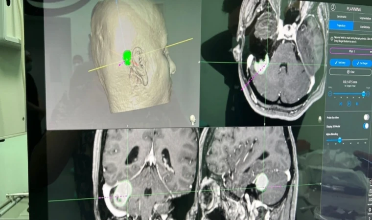Konya’da beyin ameliyatlarında başarı oranı yüksek